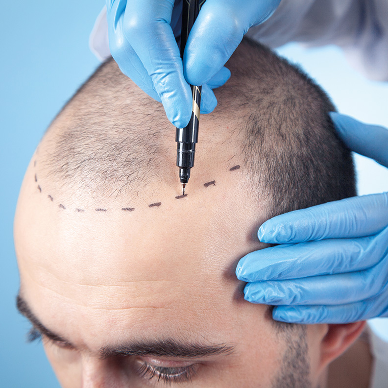 زراعة الشعر