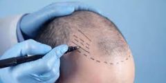 زراعة الشعر