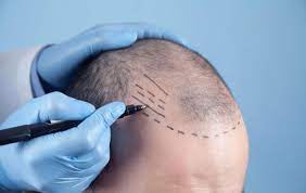 زراعة الشعر