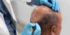 أحدث تقنيات زراعة الشعر