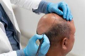 أحدث تقنيات زراعة الشعر