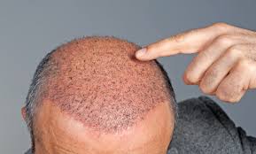 زراعة الشعر بالاستنساخ