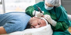 تقنية FUE لزراعة الشعر
