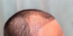 تساقط الشعر بعد الزراعة