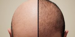 زراعة الشعر الصناعي