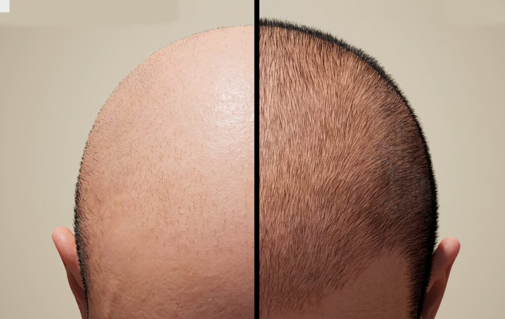 زراعة الشعر الصناعي