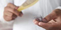 أسباب تساقط الشعر عند الأطفال
